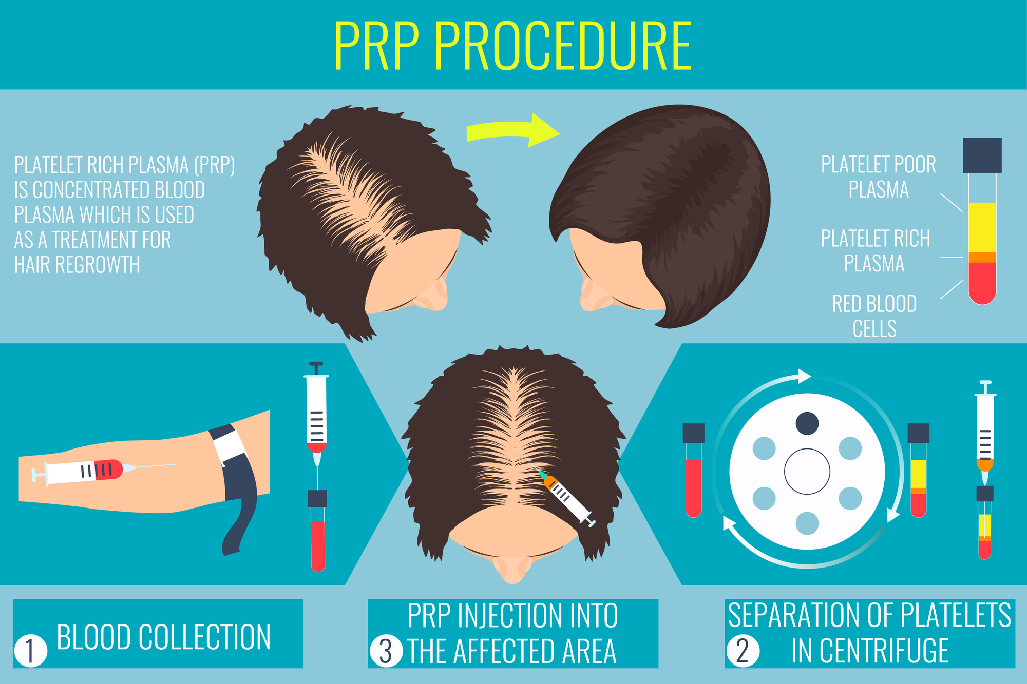 Read more about the article How Platelet Rich Plasma (PRP) Treatments Can Stimulate Hair Growth