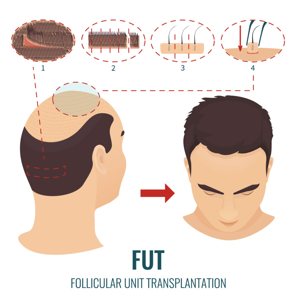 FUT Hair Transplant Los Angeles