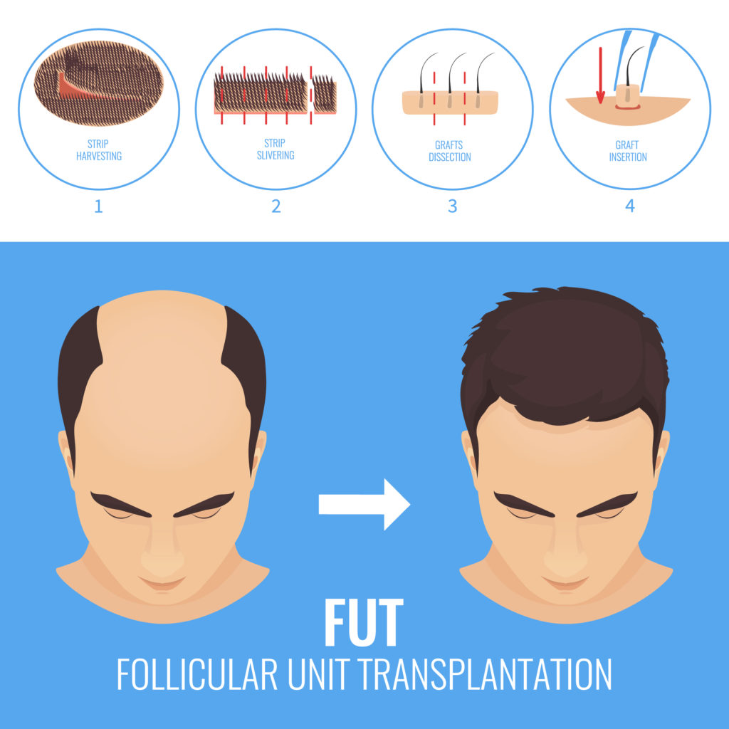 Does FUT hair treatment actually work?