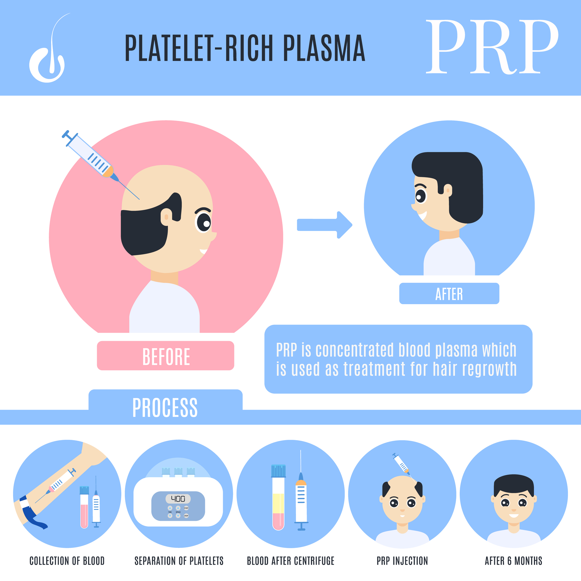 You are currently viewing What should I know about PRP hair treatment for male hair loss?