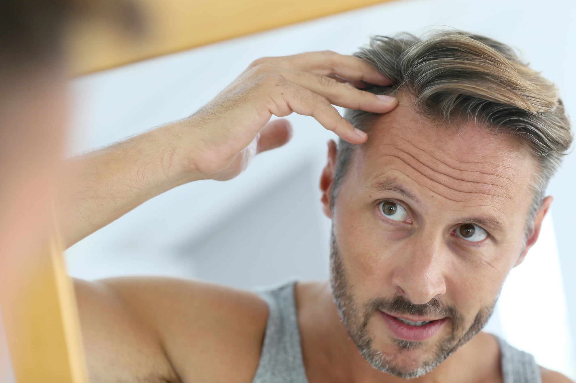 Read more about the article What is Involved with Follicular Unit Excision (FUE) Hair Treatment?