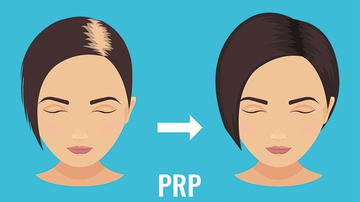 Is PRP Treatment Effective for Hair Growth